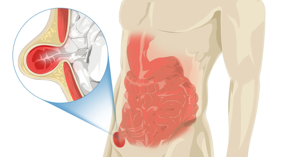 Stomach Pain, Zoom-in Inguinal Hernia