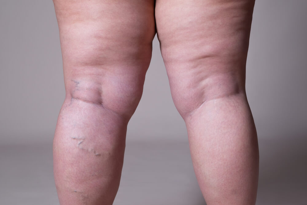 Varicose Veins Closeup