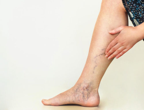 6 Risk Factors for Varicose Veins