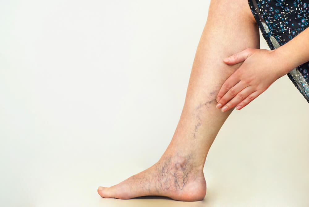 Varicose Veins on the Woman's Leg