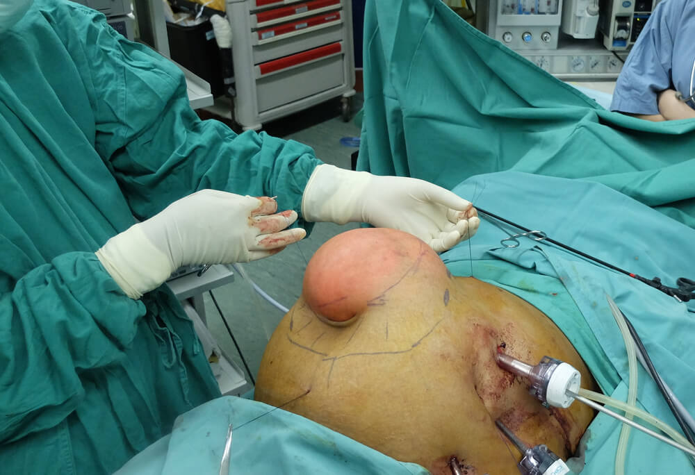 Repair of Huge Ventral Hernia