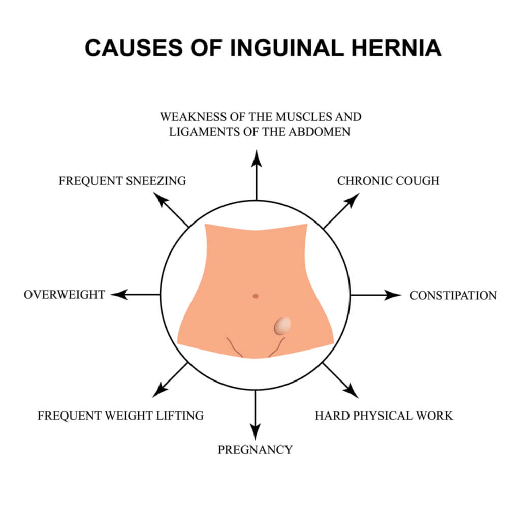 Causes of Inguinal Hernia - Infographics