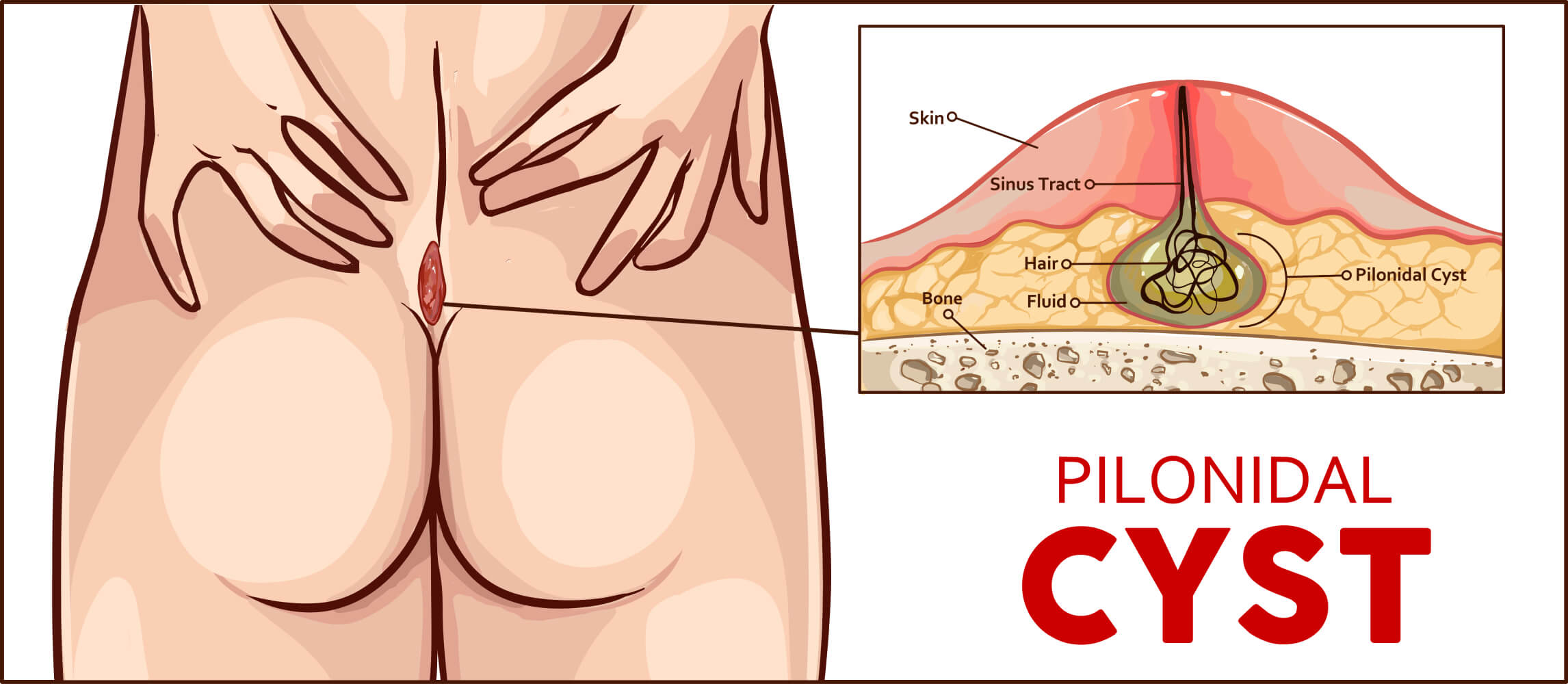 Pros and Cons of each form of Pilonidal Cyst Treatment - Surgery Group LA
