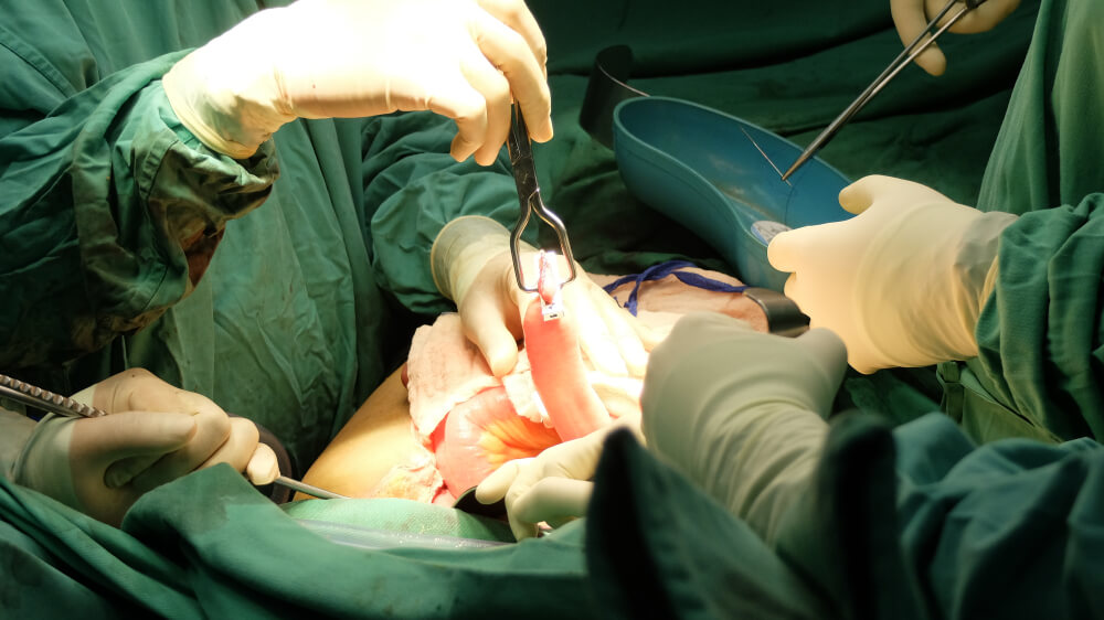 Surgeon Performing Surgery of Subtotal Colectomy in Colon Cancer Using Stappler