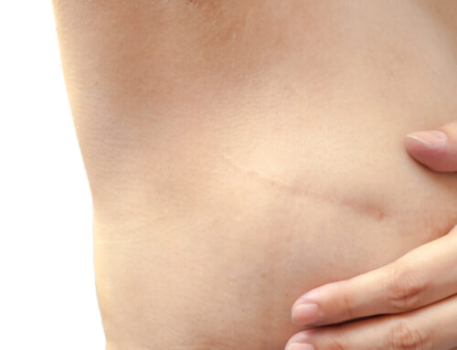 What Are the Benefits of Skin Sparing Mastectomy?