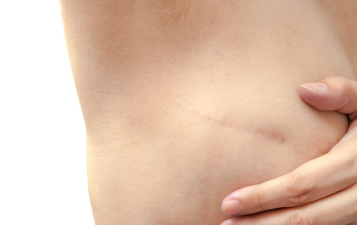 Scar From Breast Cancer Operation