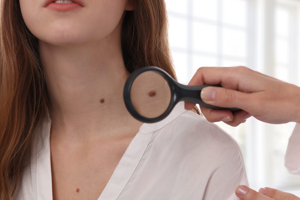 Doctor Dermatologist Examines Birthmark of Patient.