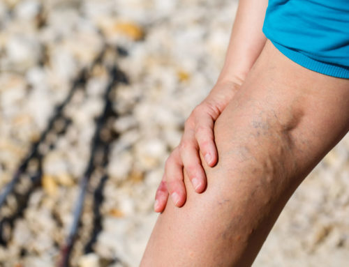 How Can I Get Rid Of Varicose Veins Without Surgery?