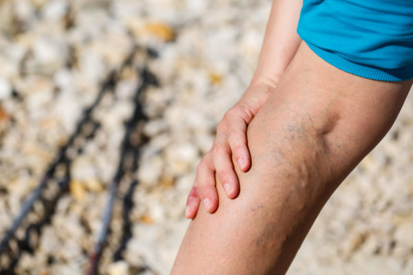 How Can I Get Rid Of Varicose Veins Without Surgery Advanced 