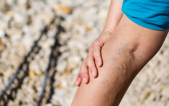 Woman Touching Painful Varicose Veins on a Leg