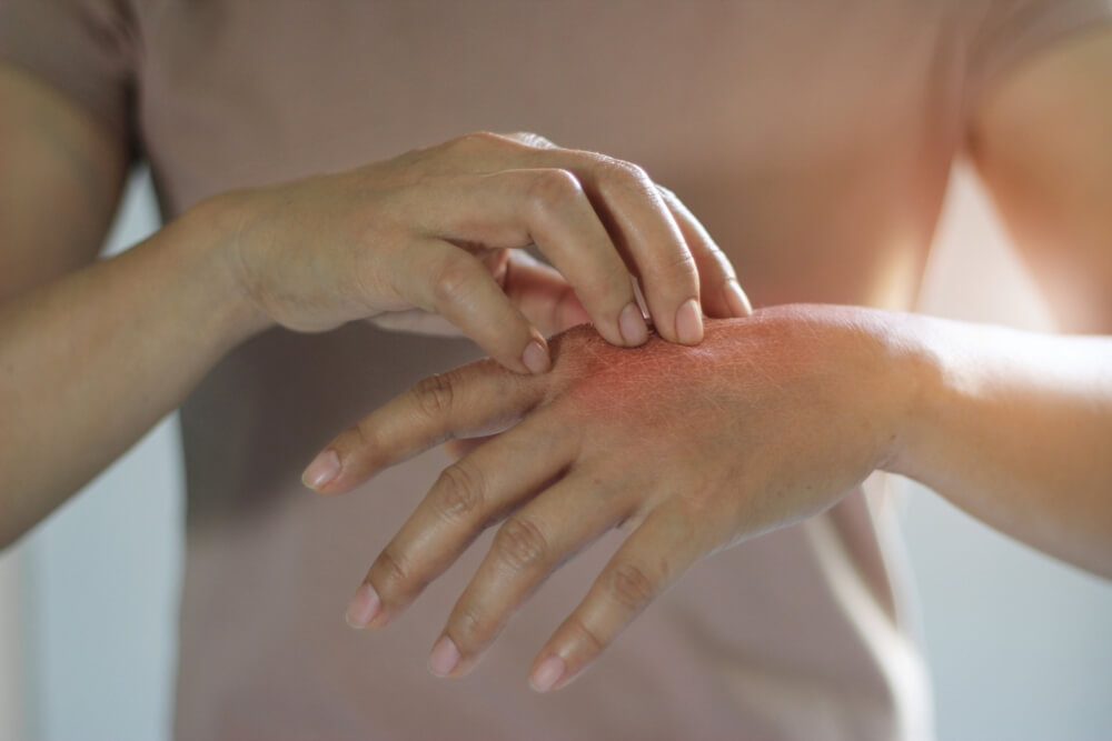Female Scratching the Itch on Her Hand, Cause of Itching From Skin Diseases