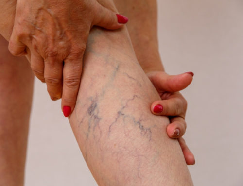 How To Prevent Varicose Veins