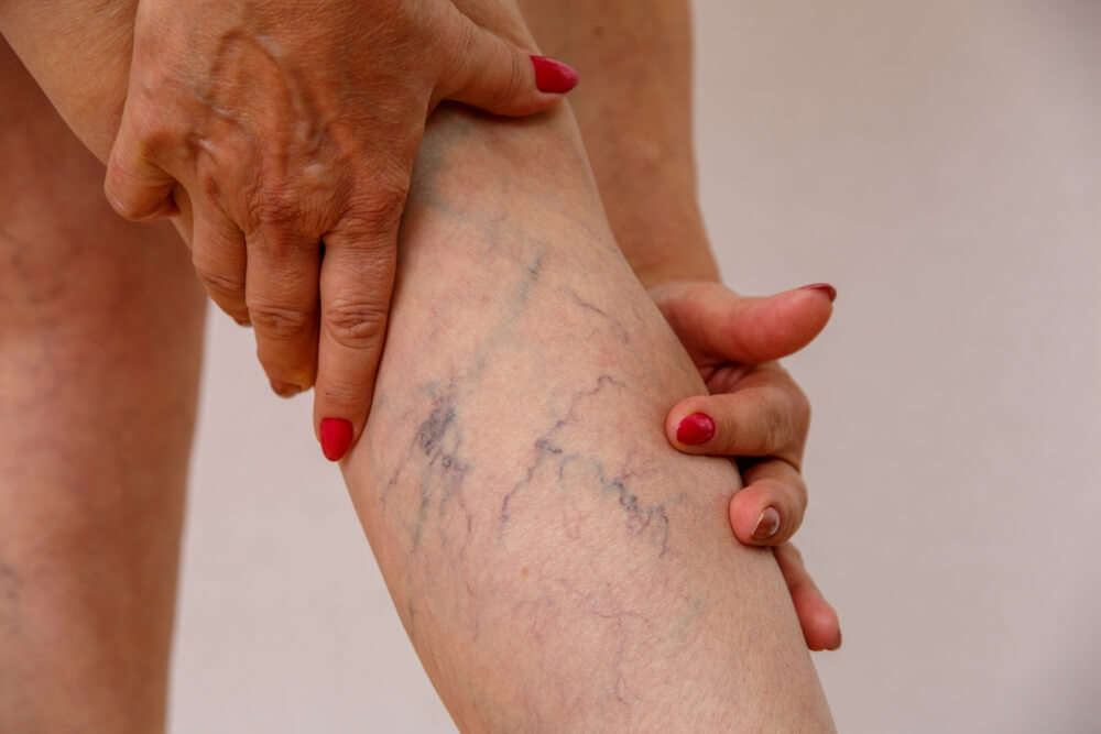 How To Prevent Varicose Veins