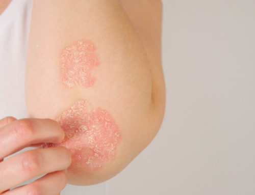 Skin Lesions: Spotting Red Flags