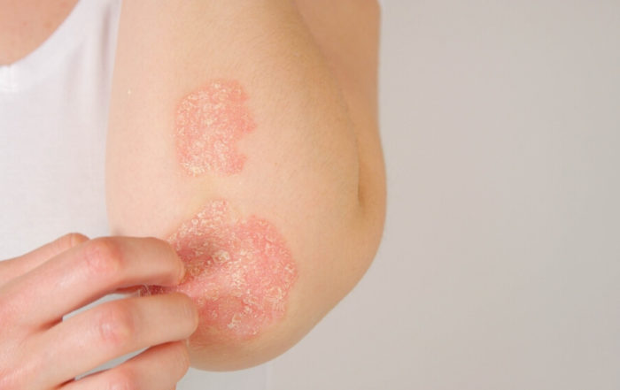 Female Patient Suffering From Psoriasis Skin Disease