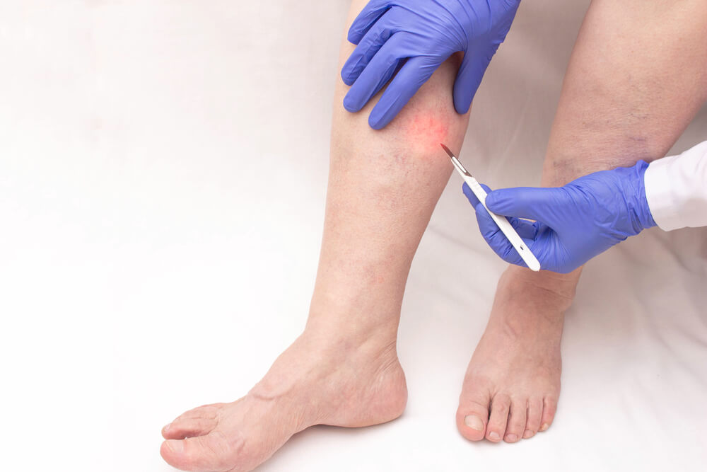 A Phlebologist Holds a Scalpel Near the Patient’s Leg of a Woman Who Has Varicose Veins in Her Legs.