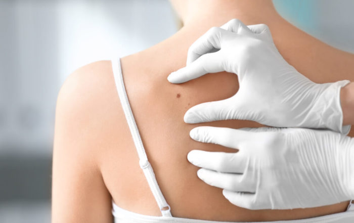 Dermatologist Examining Birthmark of Patient, Closeup.