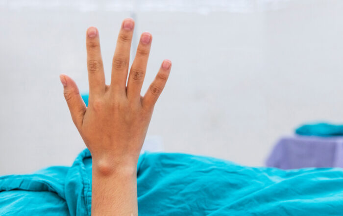 Close Up Photo Of Right Hand With Carpal Ganglion Cyst At Dorsal Of Wrist