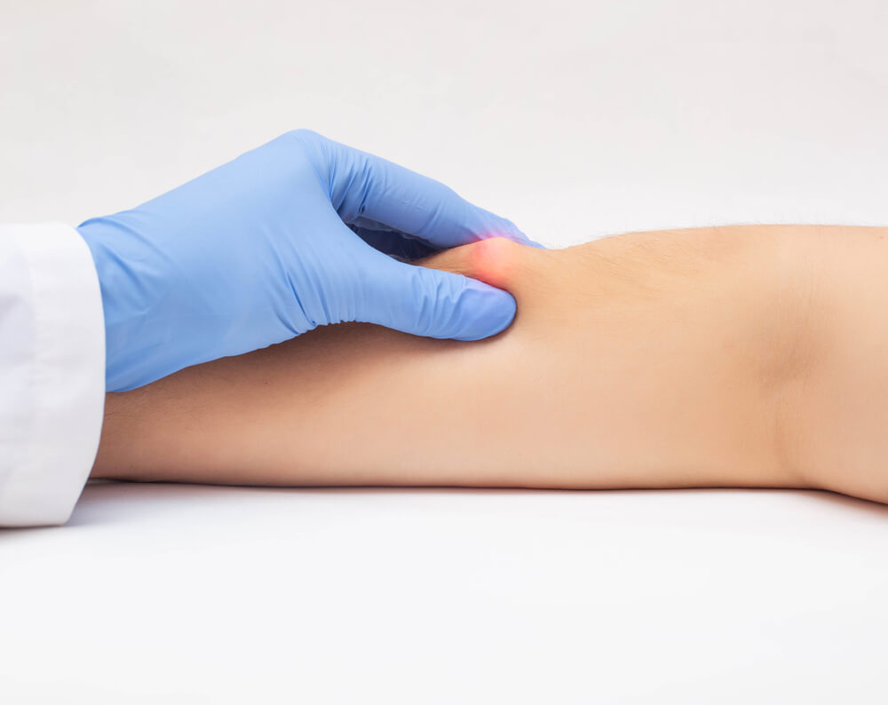 Doctor Dermatologist Examines The Subcutaneous Wen On The Patients Arm Close-up