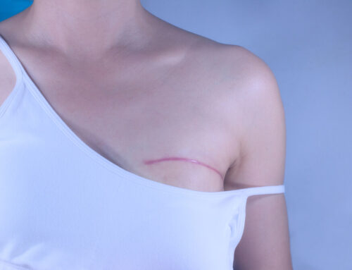 Types of Mastectomy