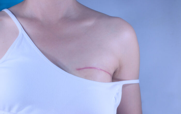 Breast cancer surgery scars by partial mastectomy
