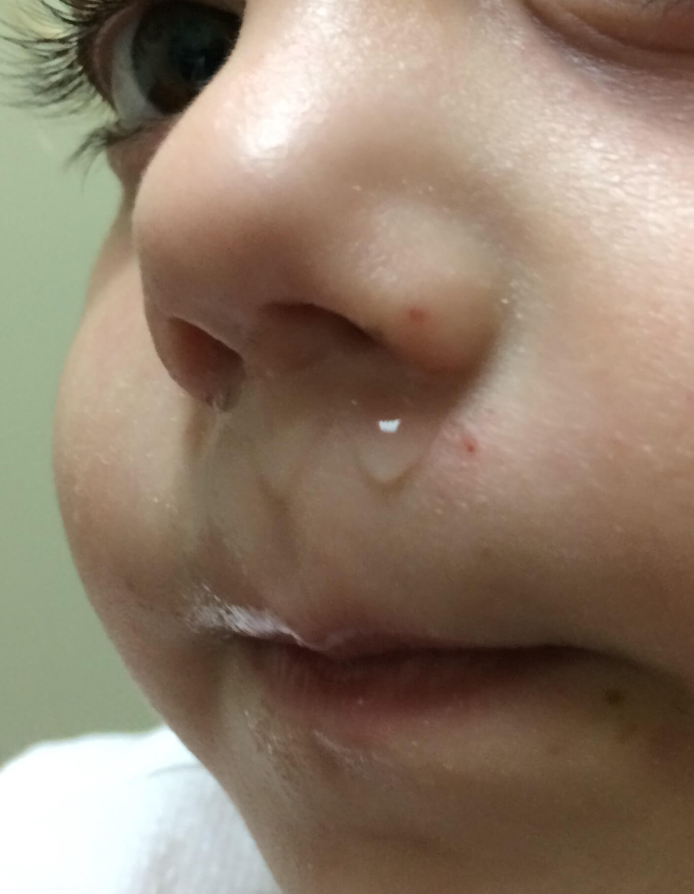 A side image of a infant patient of Allergy & Immunology Center with a nose allergy. A side image of a infant patient of Allergy & Immunology Center with a nose allergy.