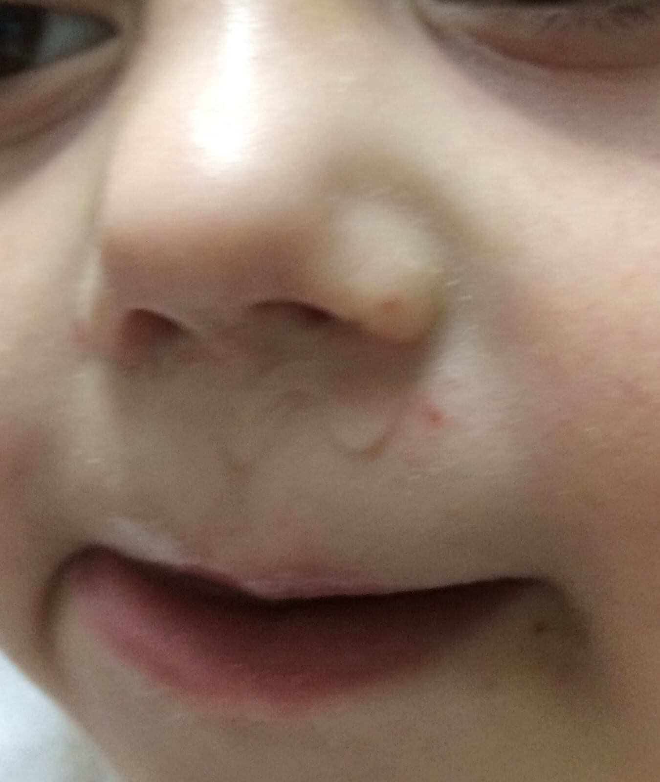 A close-up shot of a infant patient of Allergy & Immunology Center with a nose allergy. A close-up shot of a infant patient of Allergy & Immunology Center with a nose allergy.