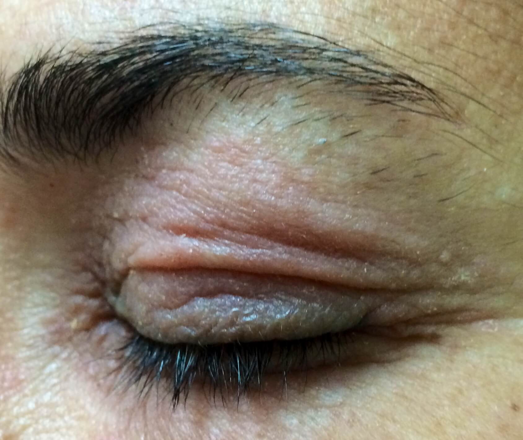 A close-up shot of a patient of Allergy & Immunology Center with redness on their eyelids. A close-up shot of a patient of Allergy & Immunology Center with redness on their eyelids.