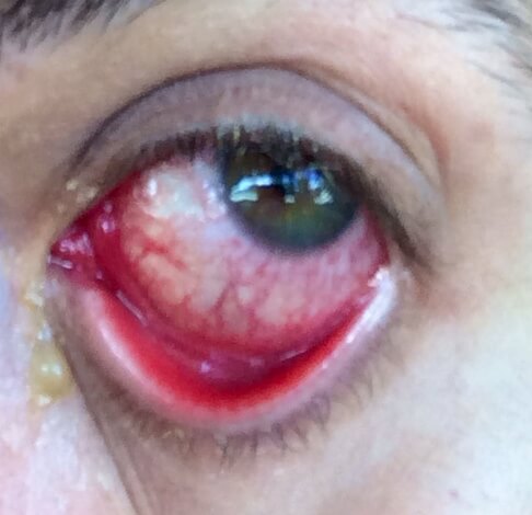 An image of a patient of Allergy & Immunology Center with an eye allergy. An image of a patient of Allergy & Immunology Center with an eye allergy.