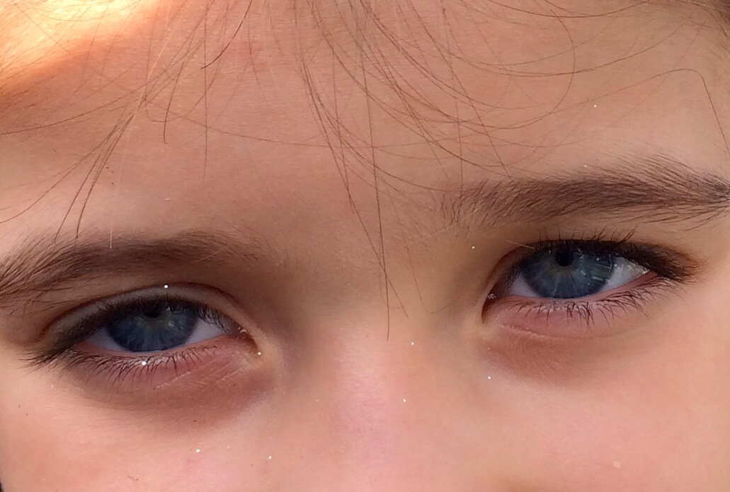 A close-up shot of a future child patient of Allergy & Immunology Center suffering from light sensitivity. A close-up shot of a future child patient of Allergy & Immunology Center suffering from light sensitivity.