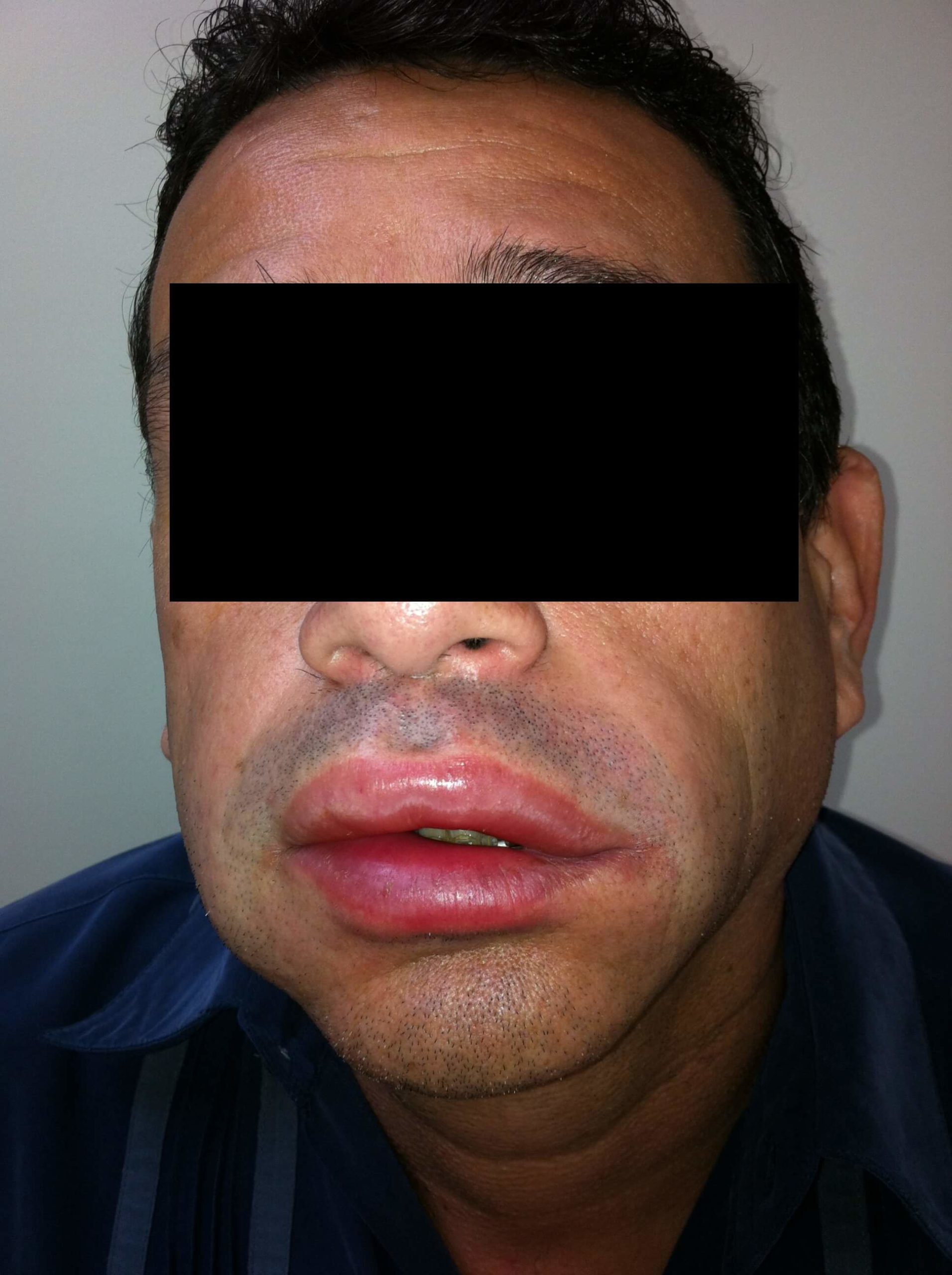 A male patient of Allergy & Immunology Center with a swollen lip due to having hives. A male patient of Allergy & Immunology Center with a swollen lip due to having hives.