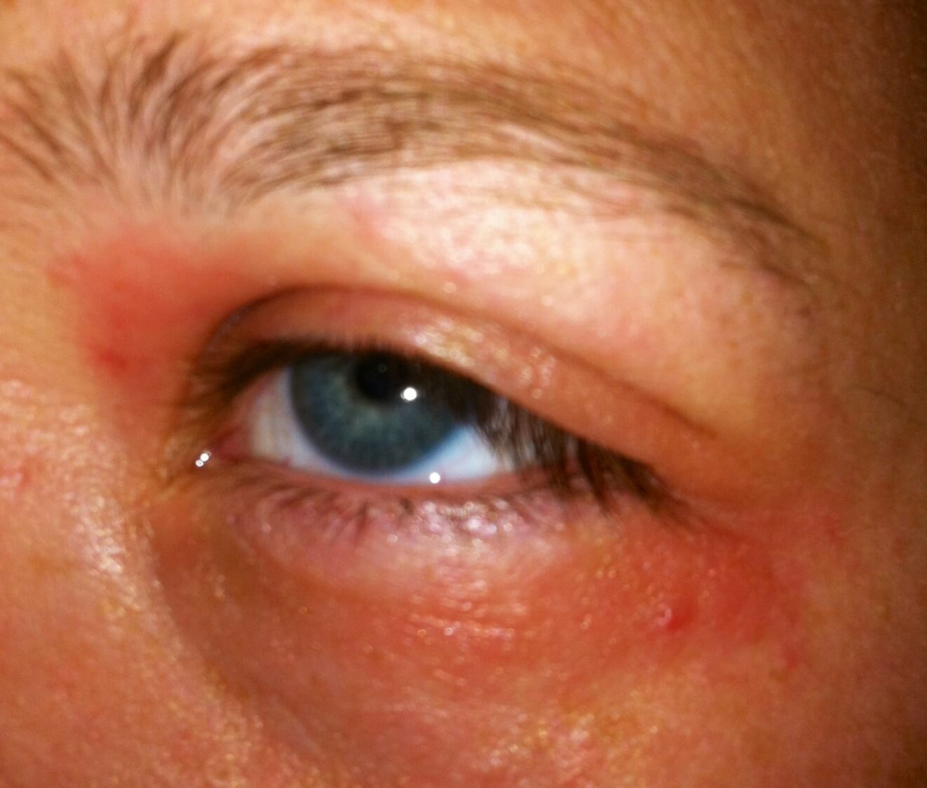 A close-up shot of a patient of Allergy & Immunology Center with eye contact dermatitis. A close-up shot of a patient of Allergy & Immunology Center with eye contact dermatitis.
