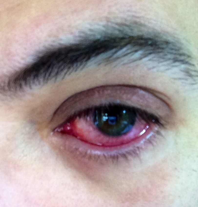 A close-up shot of a future child patient of Allergy & Immunology Center with bacterial conjunctivitis. A close-up shot of a future child patient of Allergy & Immunology Center with bacterial conjunctivitis.