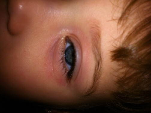 A close-up shot of a future child patient of Allergy & Immunology Center with eye contact dermatitis. A close-up shot of a future child patient of Allergy & Immunology Center with eye contact dermatitis.