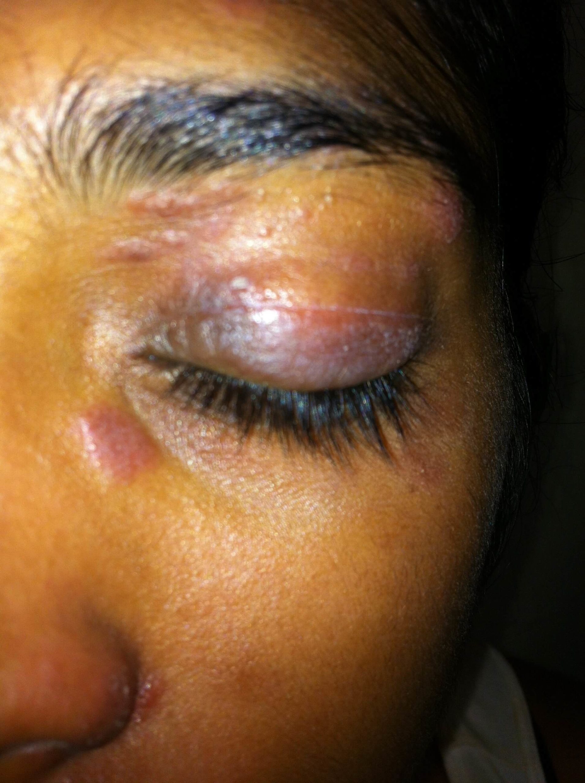 A close-up shot of a future patient of Allergy & Immunology Center with dark contact dermatitis on their eyelids. A close-up shot of a future patient of Allergy & Immunology Center with dark contact dermatitis on their eyelids.