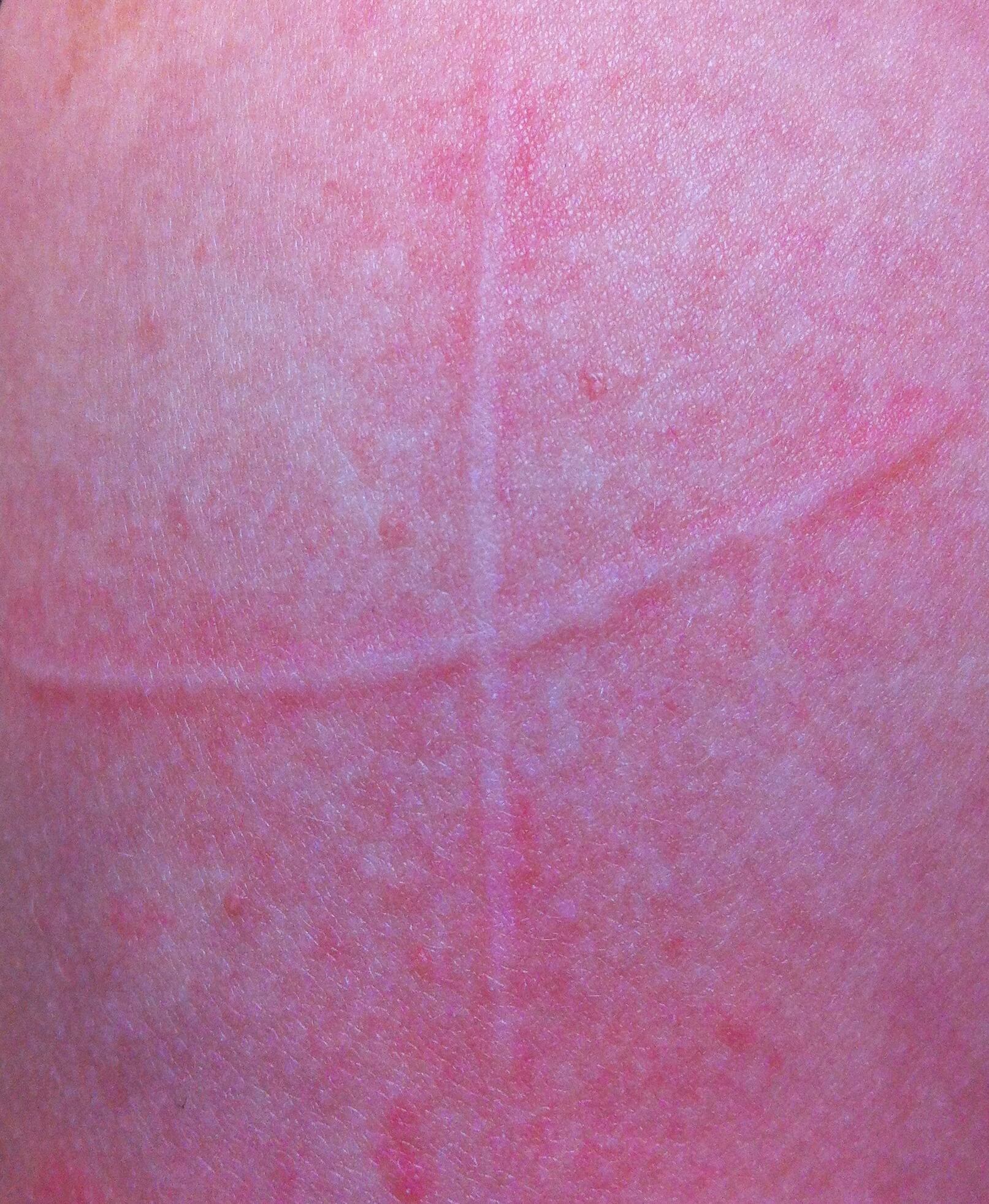 A patient of Allergy & Immunology Center with hive on their body that’s in the shape of a cross. A patient of Allergy & Immunology Center with hive on their body that's in the shape of a cross.