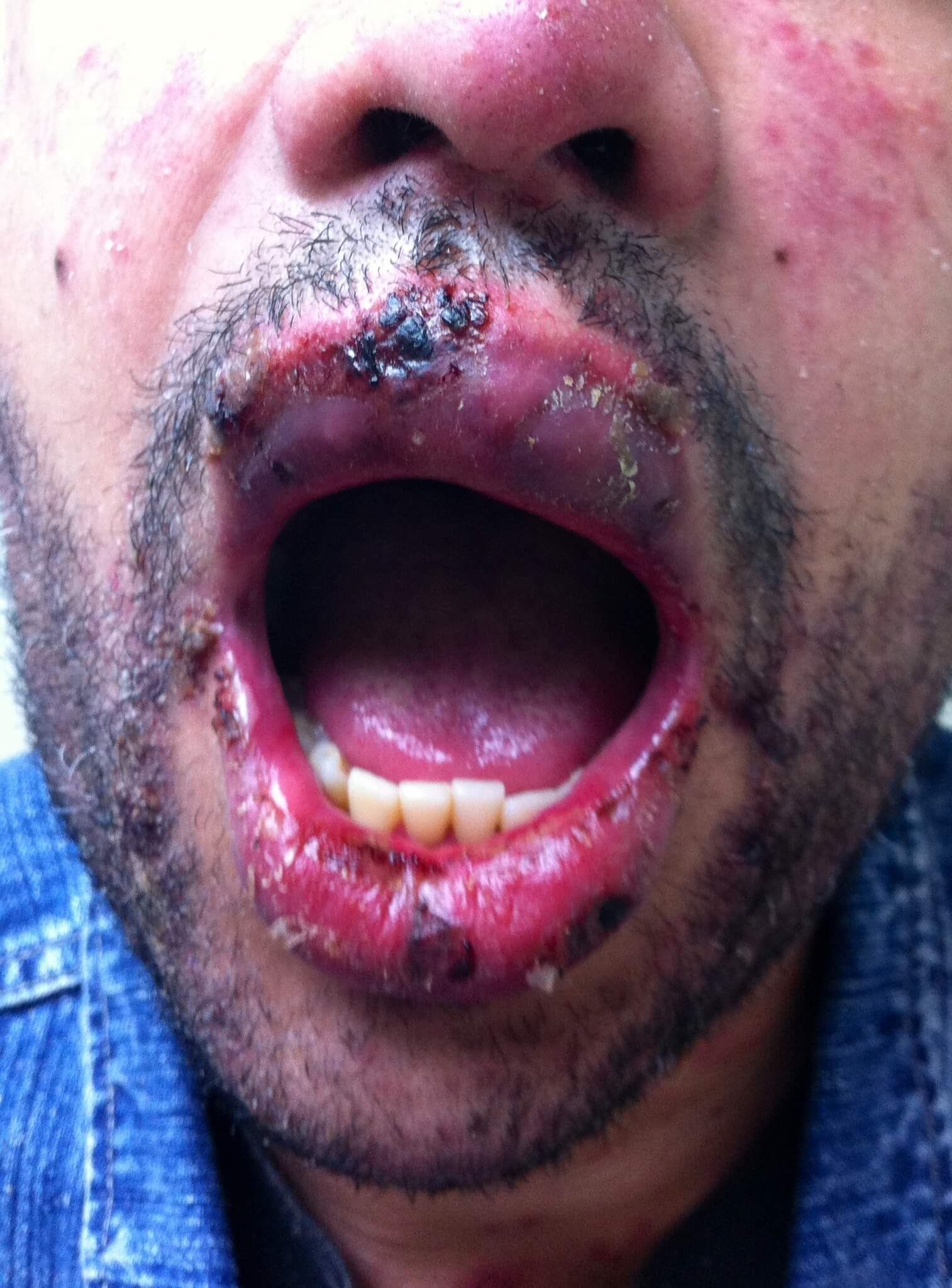 A future patient of Allergy & Immunology Center with a drug rash around their mouth. A future patient of Allergy & Immunology Center with a drug rash around their mouth.