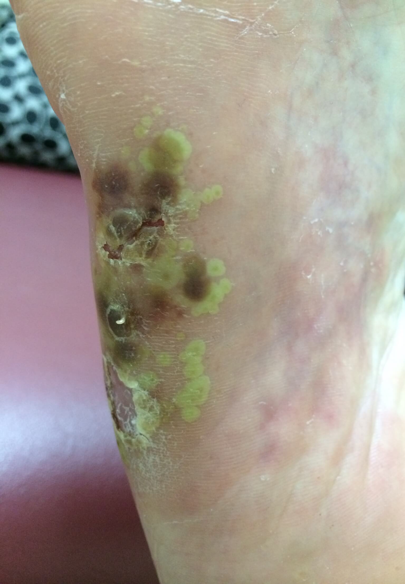 A patient of Allergy & Immunology Center with dyshidrotic eczema on the bottom of their foot. A patient of Allergy & Immunology Center with dyshidrotic eczema on the bottom of their foot.