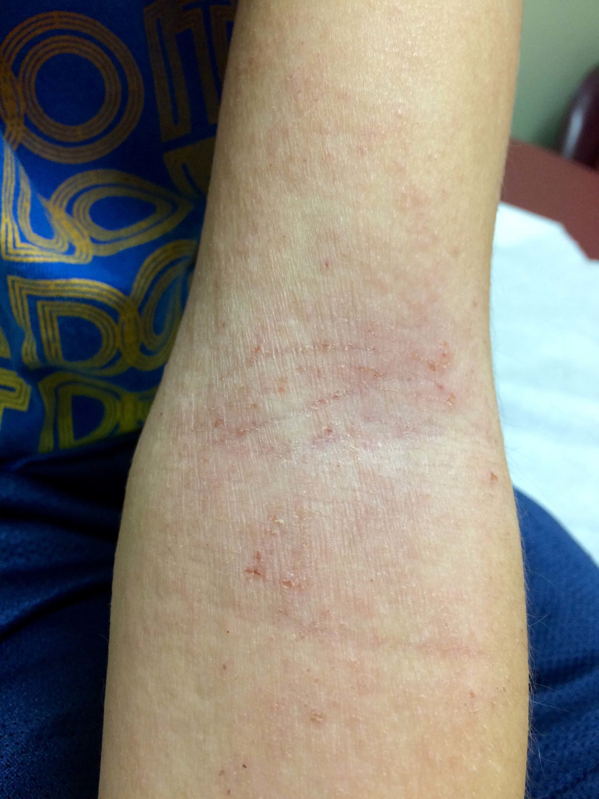 tobacco allergy skin rash cigarette smoke How Smoking Impacts the Dermatitis: Causes, Symptoms, and Treatments