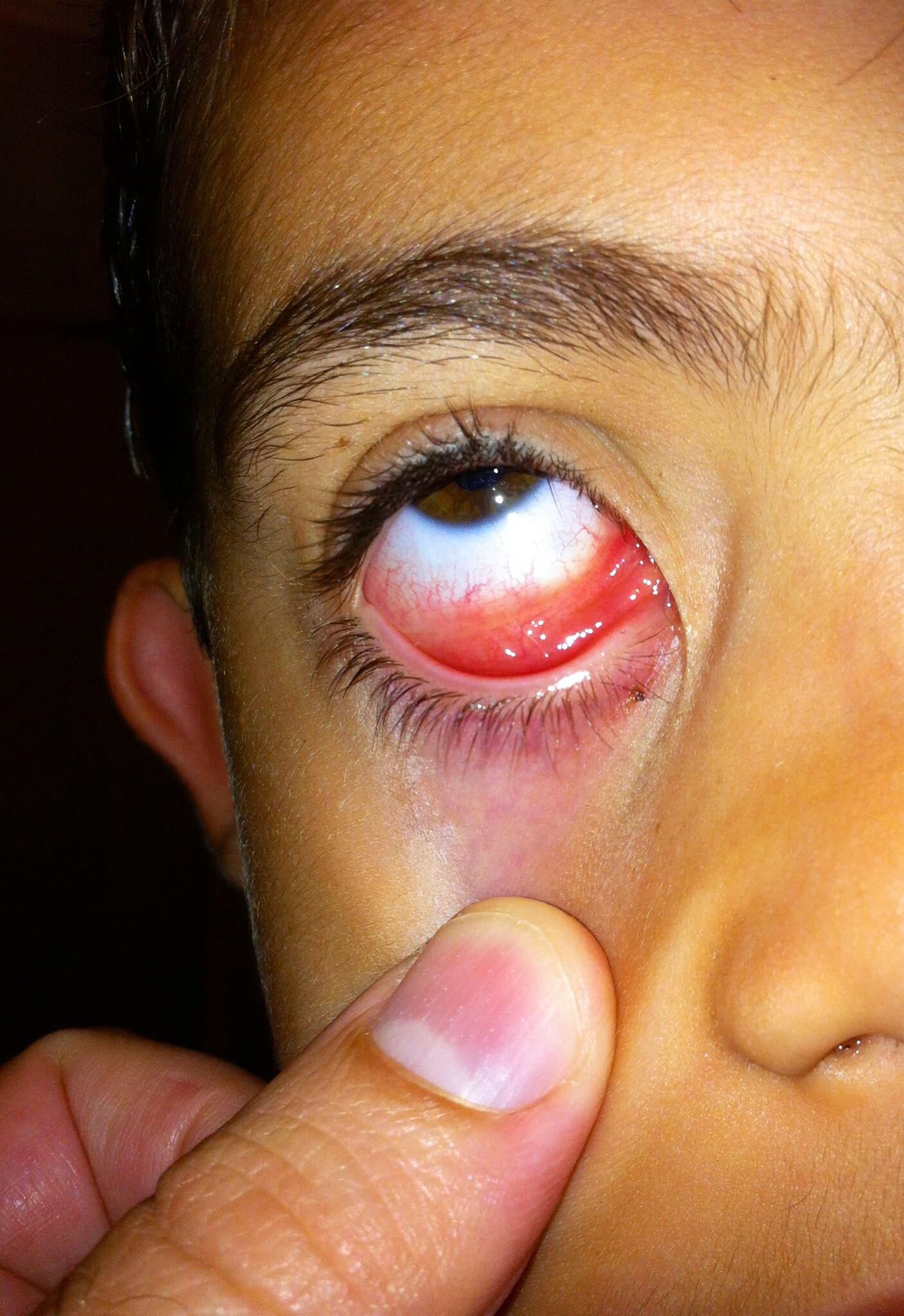 great-conjunctivitis A close-up shot of a future patient of Allergy & Immunology Center with conjunctivitis.
