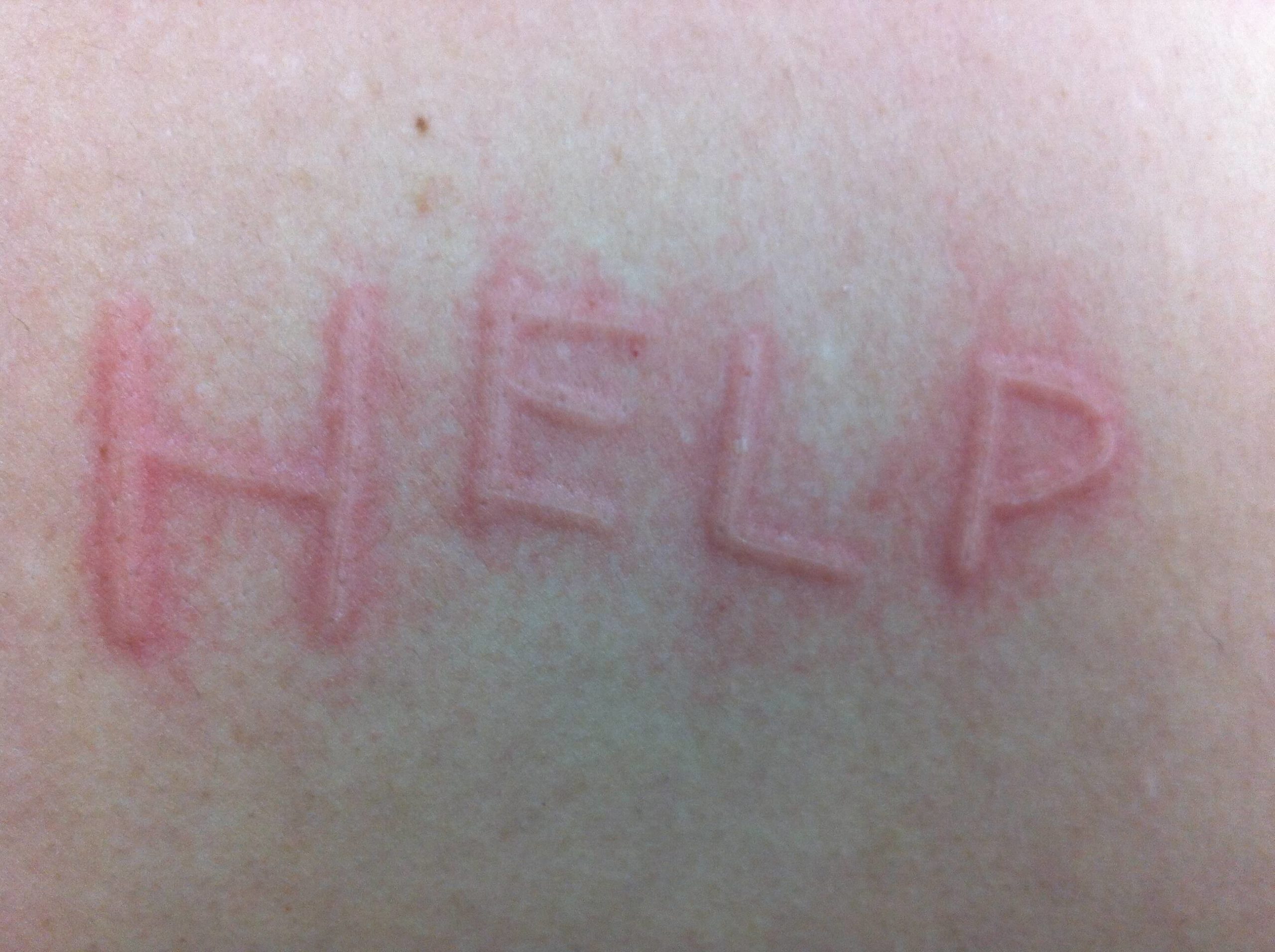A patient of Allergy & Immunology Center with a hive on their body that spells out the word help. A patient of Allergy & Immunology Center with a hive on their body that spells out the word help.