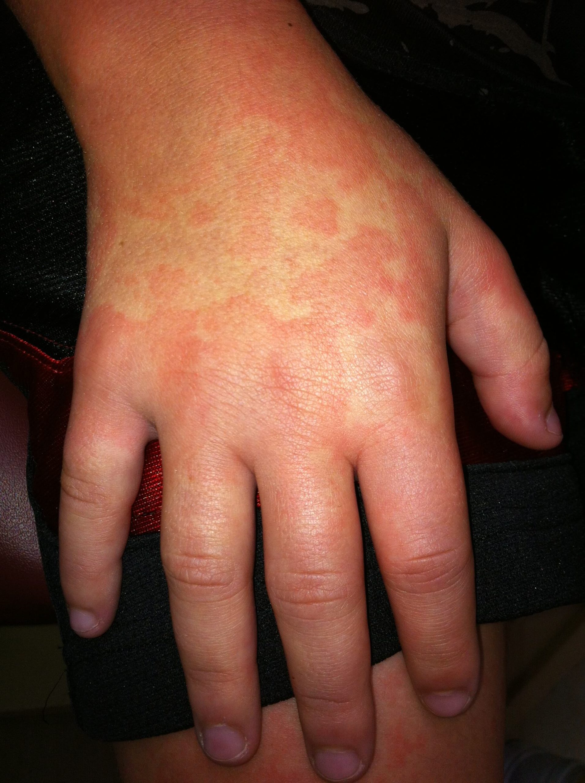 A future child patient of Allergy & Immunology Center with hives on his hands. A future child patient of Allergy & Immunology Center with hives on his hands.