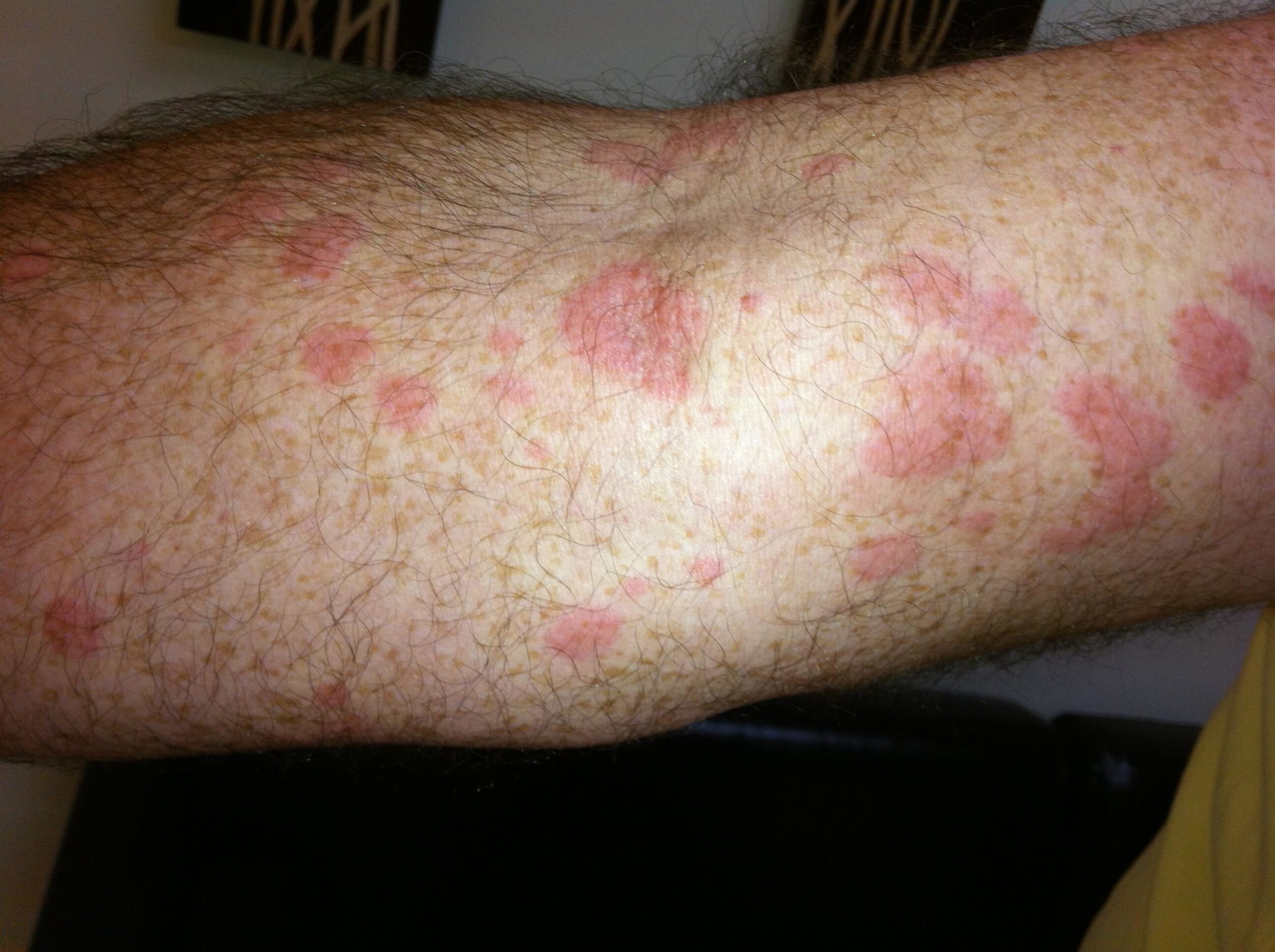 A future male patient of Allergy & Immunology Center with hives on his forearm. A future male patient of Allergy & Immunology Center with hives on his forearm.