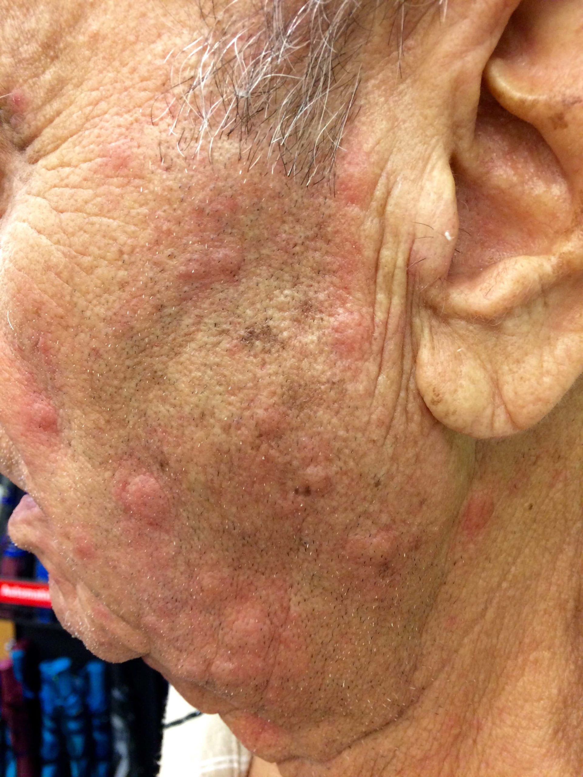 A patient of Allergy & Immunology Center with hives on the side of their face. A patient of Allergy & Immunology Center with hives on the side of their face.