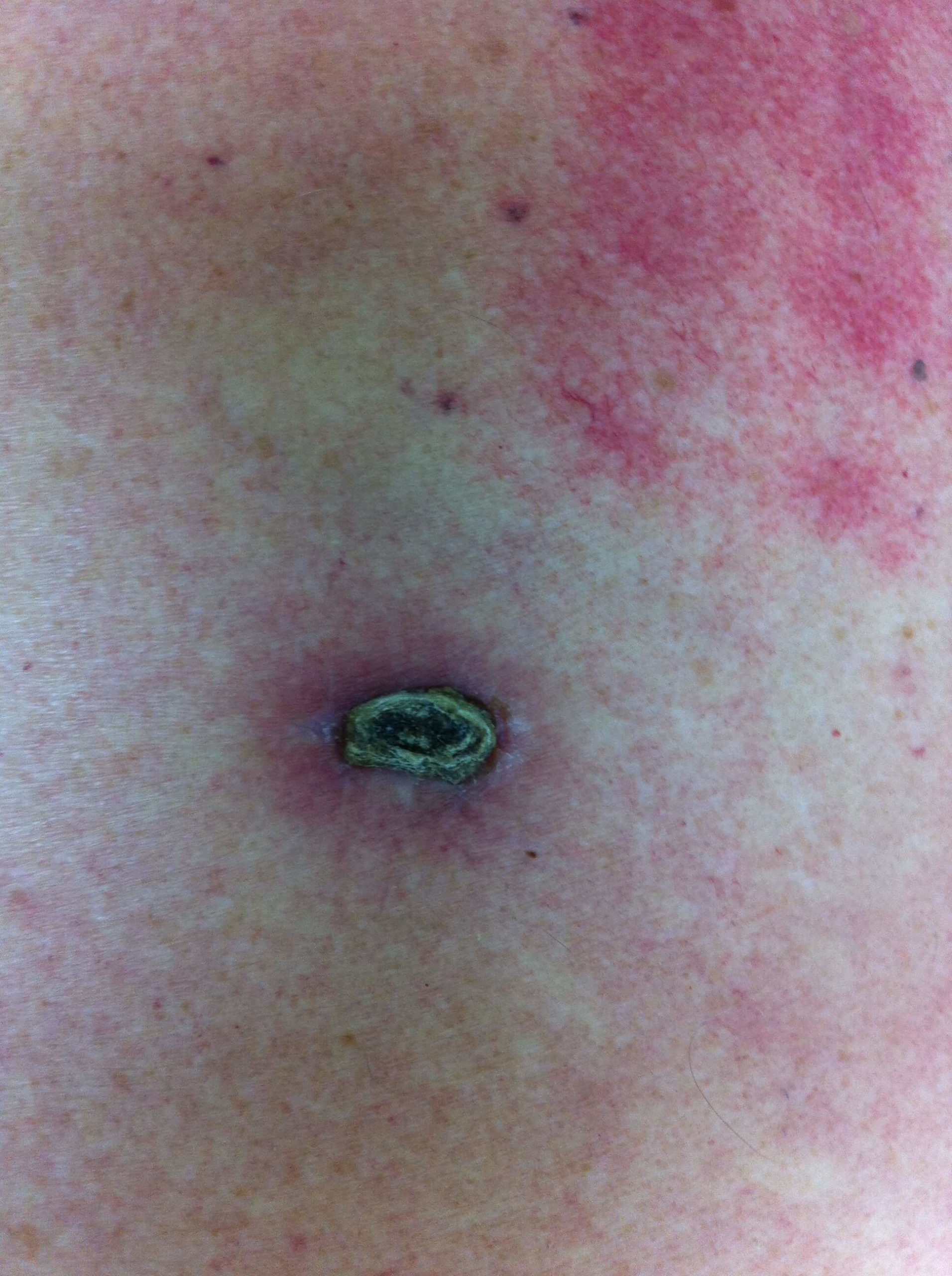 A close-up shot of a patient of Allergy & Immunology Center with a fungal infection. A close-up shot of a patient of Allergy & Immunology Center with a fungal infection.