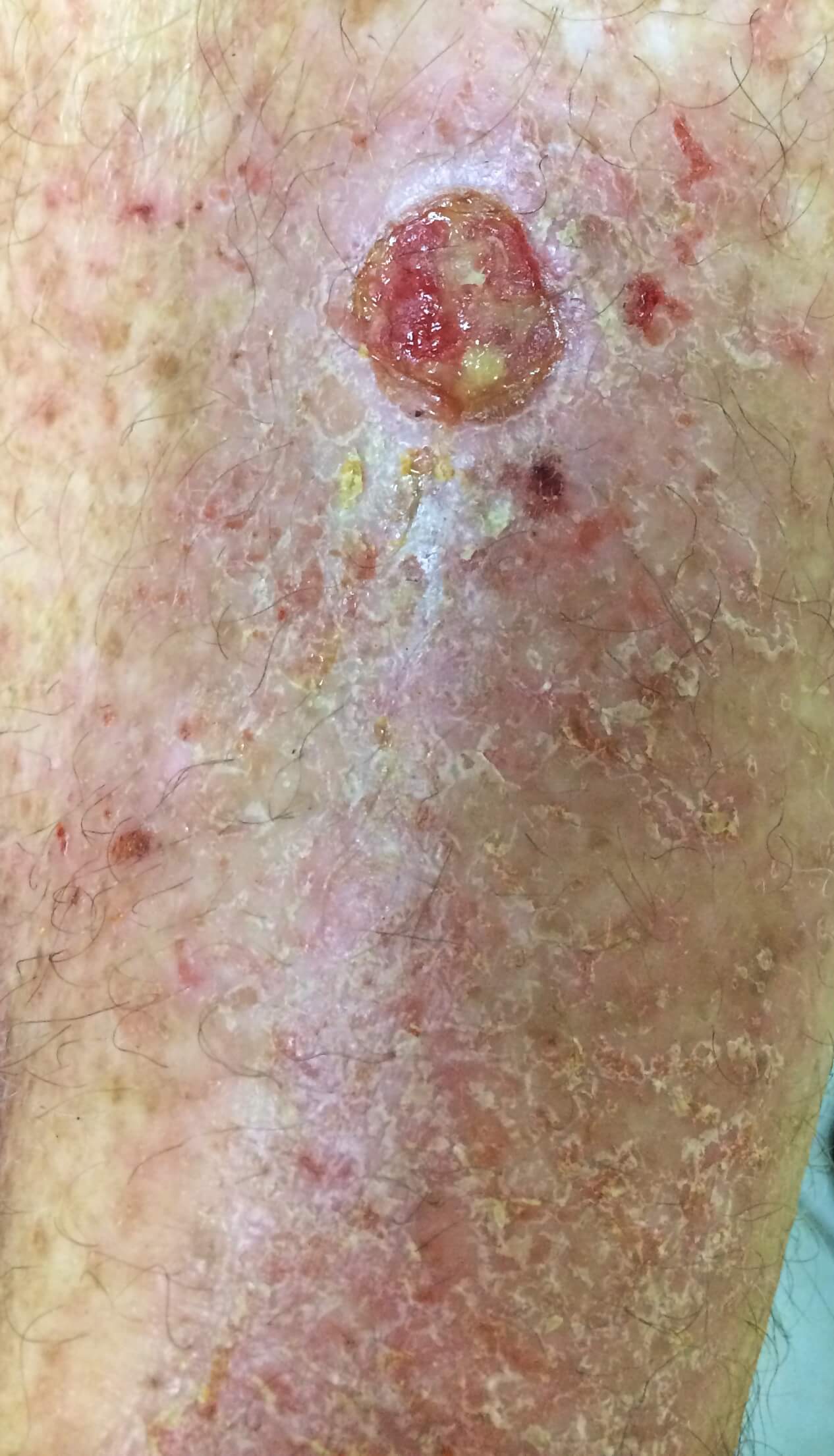 A close-up shot of a patient of Allergy & Immunology Center with an infection on their leg. A close-up shot of a patient of Allergy & Immunology Center with an infection on their leg.