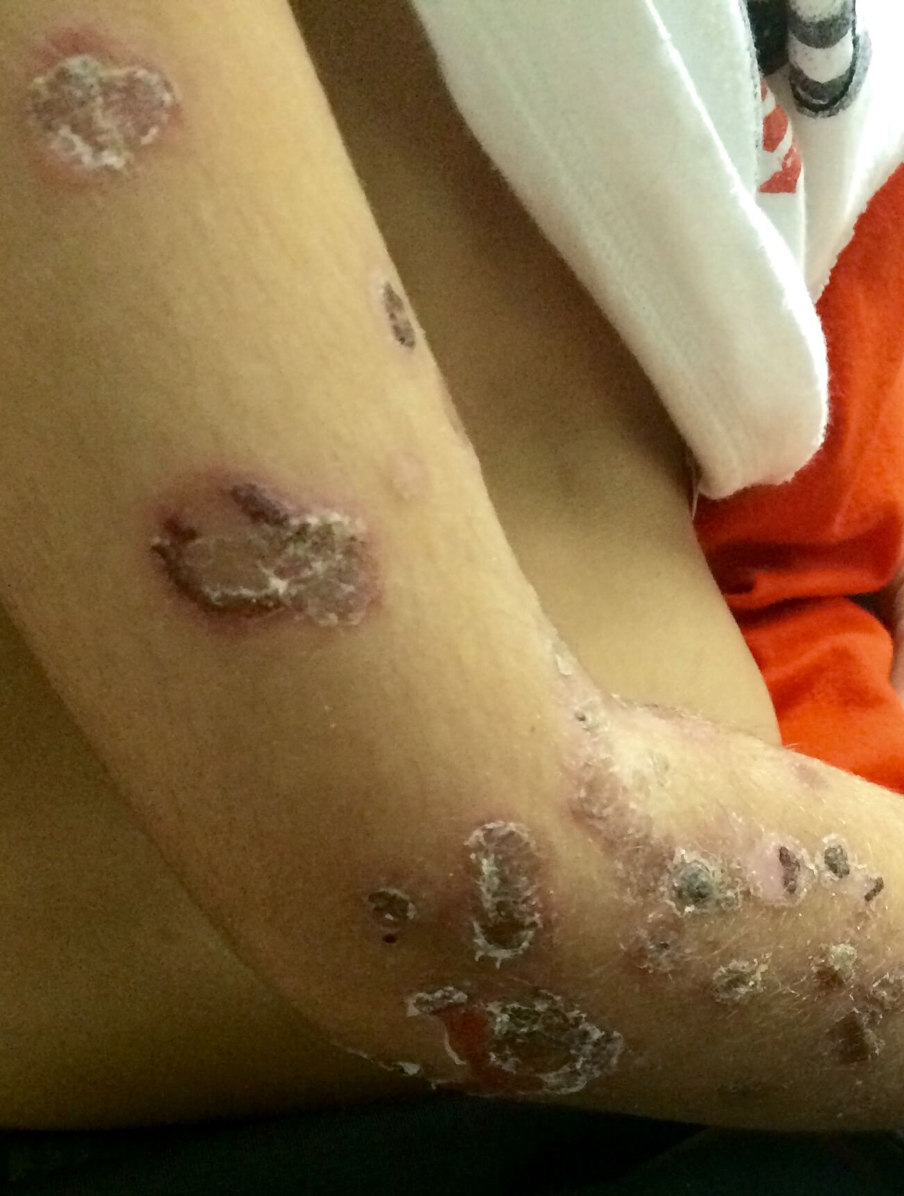 A close-up shot of a patient of Allergy & Immunology Center with an infection on their arm. A close-up shot of a patient of Allergy & Immunology Center with an infection on their arm.
