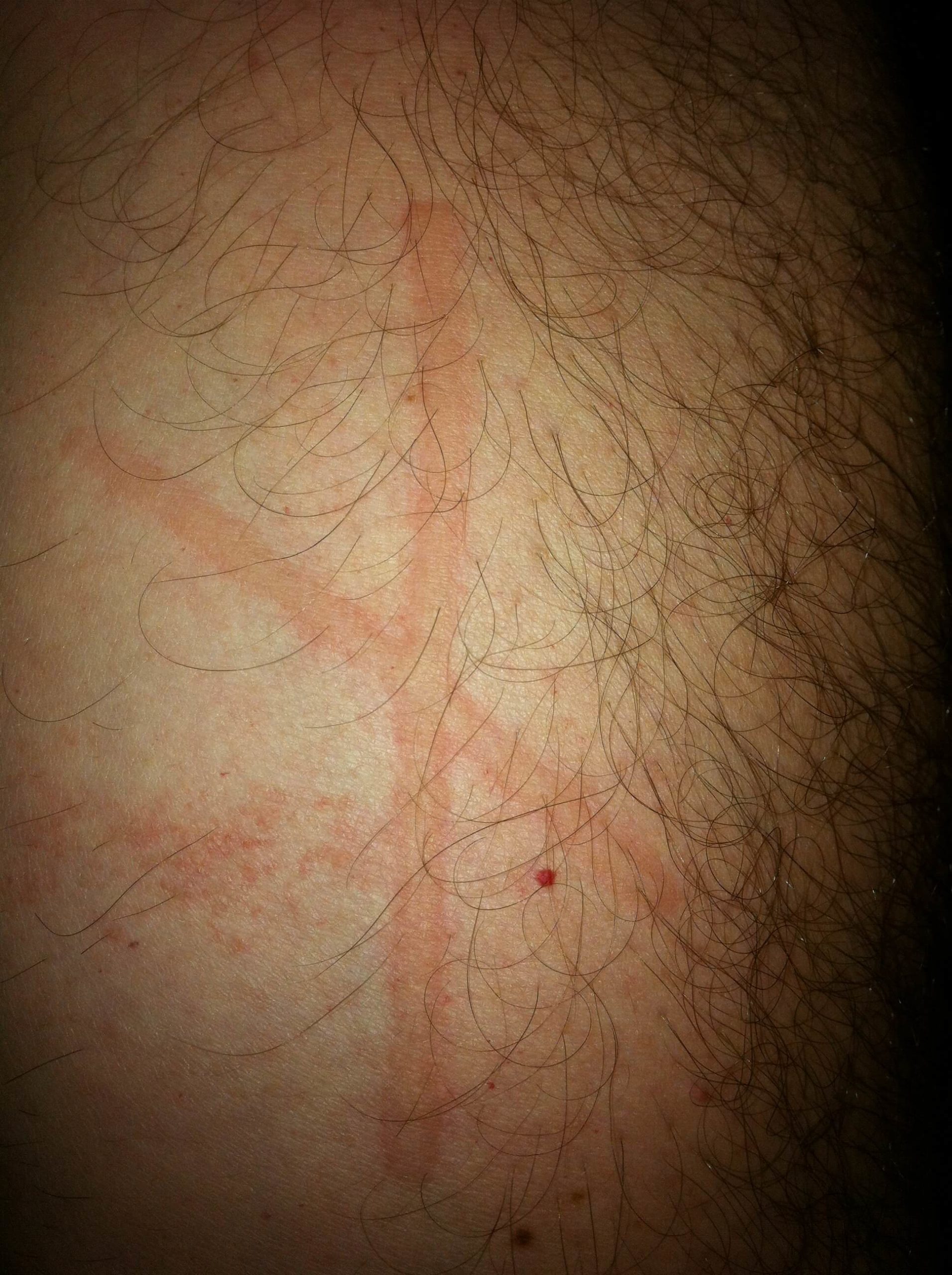 A patient of Allergy & Immunology Center with a hive on their body that’s in the shape of the letter x. A patient of Allergy & Immunology Center with a hive on their body that's in the shape of the letter x.