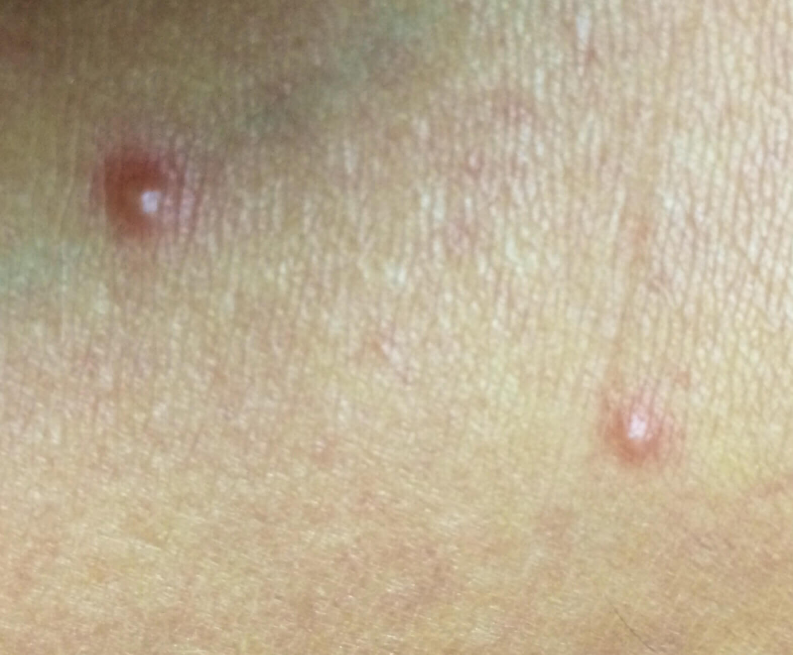 A close-up shot of a patient of Allergy & Immunology Center with molus. A close-up shot of a patient of Allergy & Immunology Center with molus.
