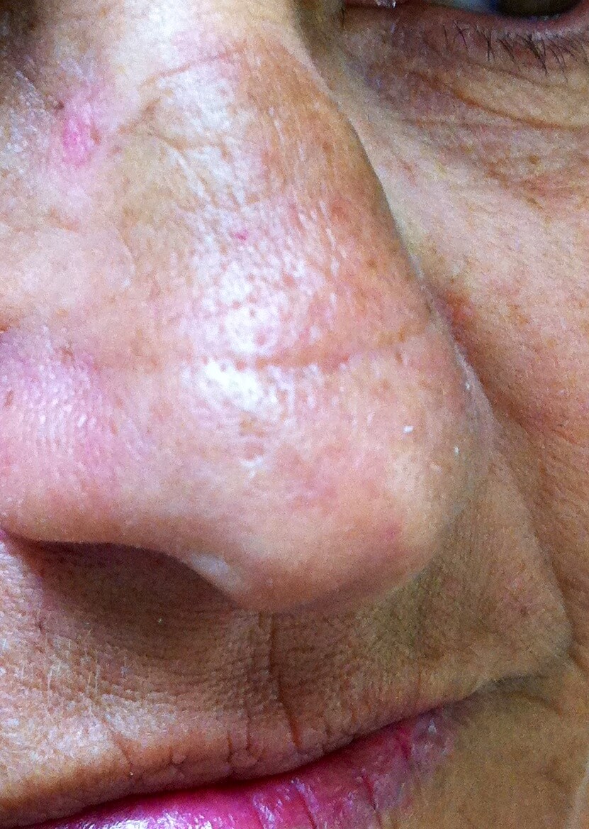 A side image of a patient of Allergy & Immunology Center with swollen nasal tissue due to having a nose allergy. A side image of a patient of Allergy & Immunology Center with swollen nasal tissue due to having a nose allergy.